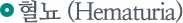 ���� (Hematuria)